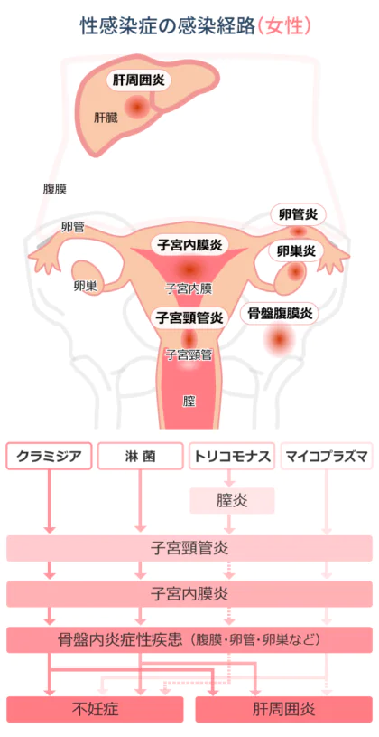 性感染症の感染経路（女性）